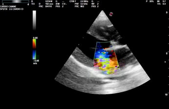 Mitral Regurgitation (MR) Color